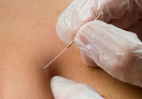 Island Acupuncture & Massage, Dry Needling